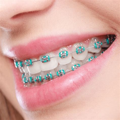 what are brackets in braces